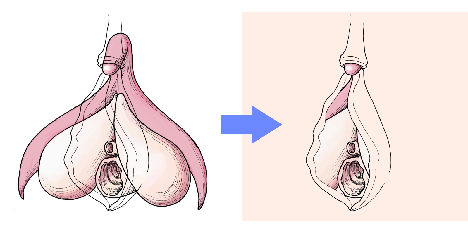 Internal and External view of the Clitoris Most of the clitoris is hidden within the body